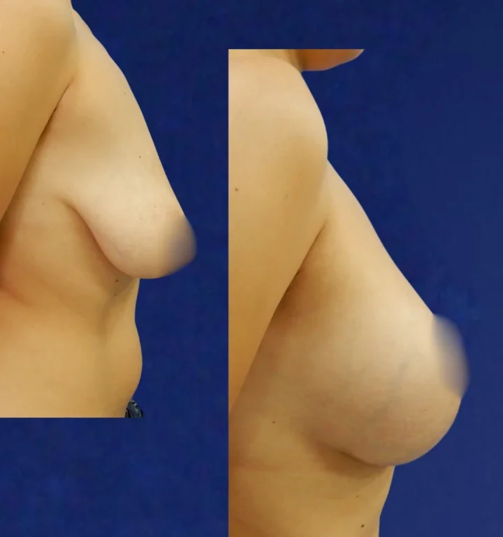 Mamoplastia-DoctorJuanOlaya-Before-After-01