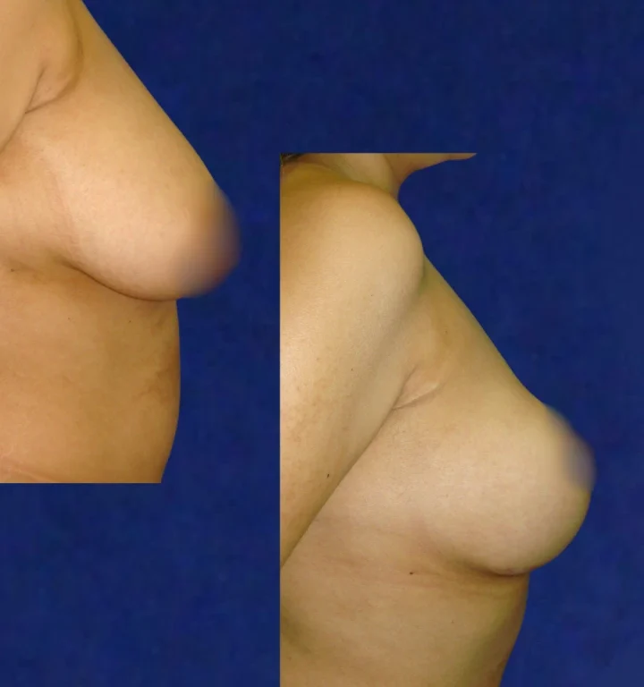 Mamoplastia-DoctorJuanOlaya-Before-After-02
