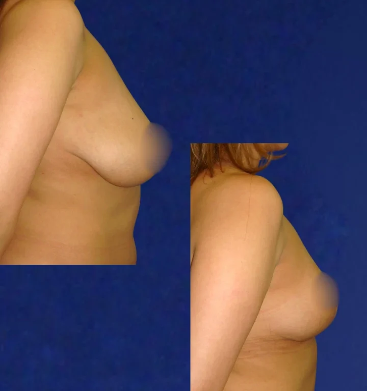 Mamoplastia-DoctorJuanOlaya-Before-After-03