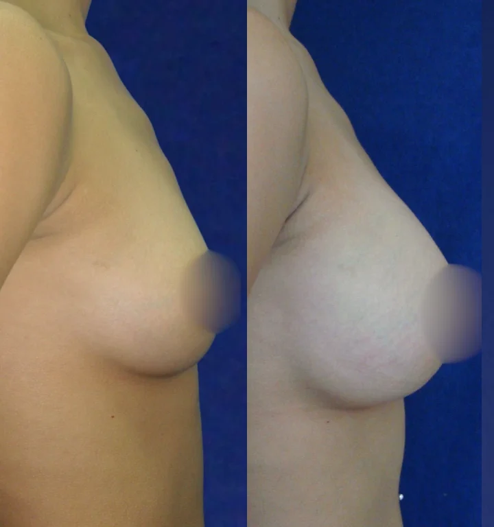 Mamoplastia-DoctorJuanOlaya-Before-After-04