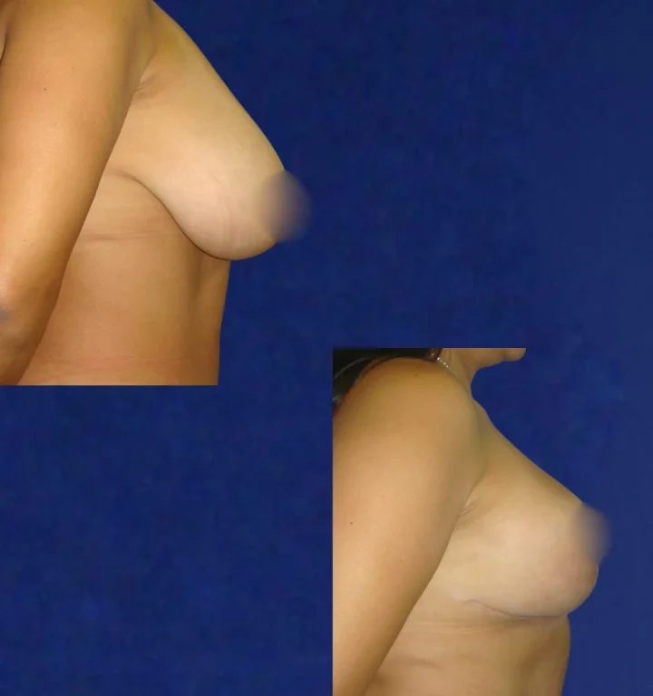 Mamoplastia-DoctorJuanOlaya-Before-After-05