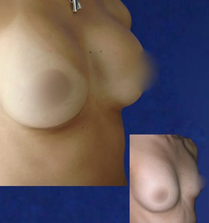 Mamoplastia-DoctorJuanOlaya-Before-After-06