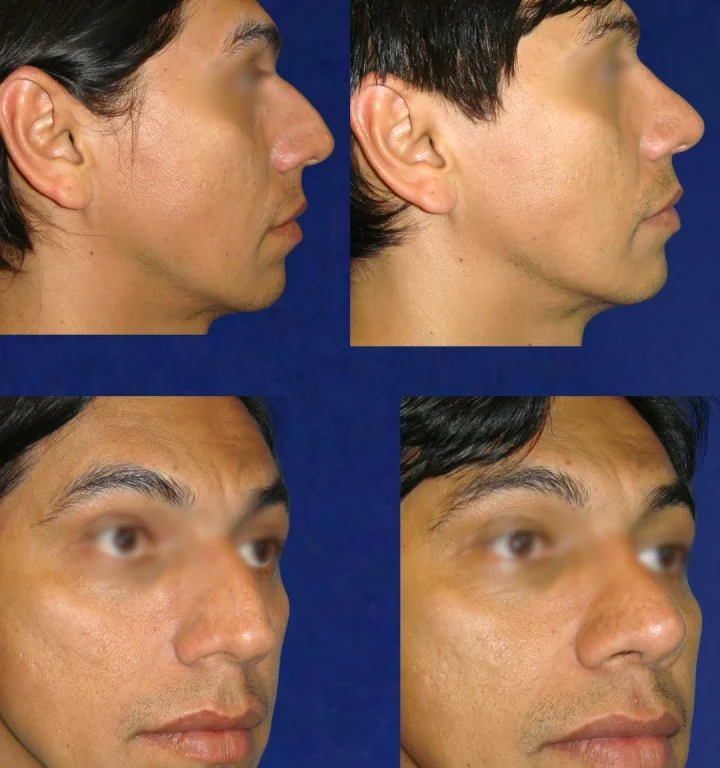 Rinoplastia-DoctorJuanOlaya-Before-After-01