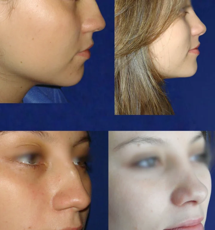 Rinoplastia-DoctorJuanOlaya-Before-After-02