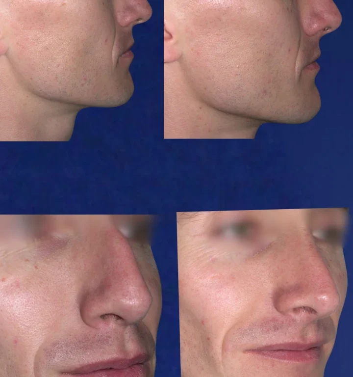 Rinoplastia-DoctorJuanOlaya-Before-After-03