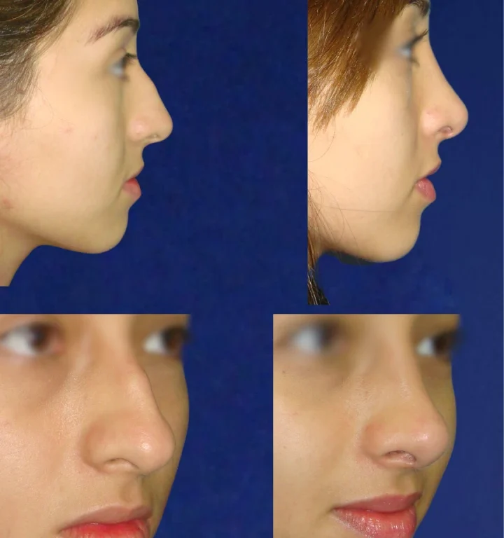 Rinoplastia-DoctorJuanOlaya-Before-After-04